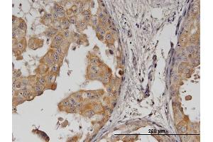 Immunoperoxidase of monoclonal antibody to ERBB2 on formalin-fixed paraffin-embedded human breast cancer. (ErbB2/Her2 antibody  (AA 22-121))