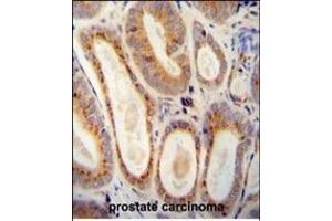 WFDC12 antibody (C-term) (ABIN654327 and ABIN2844104) immunohistochemistry analysis in formalin fixed and paraffin embedded human prostate carcinoma followed by peroxidase conjugation of the secondary antibody and DAB staining. (WFDC12 antibody  (C-Term))