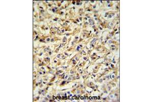 PRELP Antibody IHC analysis in formalin fixed and paraffin embedded breast carcinoma followed by peroxidase conjugation of the secondary antibody and DAB staining. (PRELP antibody  (AA 119-148))