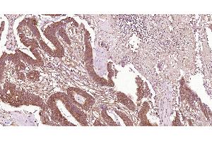 Paraformaldehyde-fixed, paraffin embedded Human colon cancer; Antigen retrieval by boiling in sodium citrate buffer (pH6. (CLEC9A antibody  (AA 101-200))