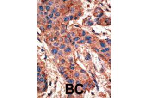 Formalin-fixed and paraffin-embedded human cancer tissue reacted with BMPR1A polyclonal antibody  , which was peroxidase-conjugated to the secondary antibody, followed by AEC staining. (BMPR1A antibody  (AA 39-69))