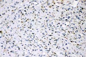 ADFP was detected in paraffin-embedded sections of human mammary cancer tissues using rabbit anti- ADFP Antigen Affinity purified polyclonal antibody (Catalog # ) at 1 µg/mL. (ADRP antibody  (AA 226-418))