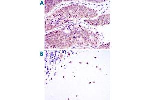 Immunohistochemical analysis of paraffin-embedded human ovarian cancer (A) and cerebellum tissues (B) using MSI2 monoclonal antibody, clone 2C11  with DAB staining. (MSI2 antibody)