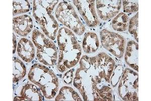 Immunohistochemical staining of paraffin-embedded Carcinoma of liver tissue using anti-RC203219 mouse monoclonal antibody. (ACSBG1 antibody)