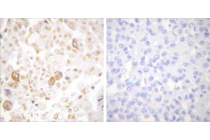 Peptide - +Immunohistochemical analysis of paraffin-embedded human breast carcinoma tissue using Cyclin F antibody (#C0168). (Cyclin F antibody)