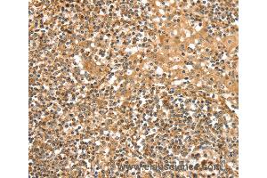 Immunohistochemistry of Human cervical cancer using SLC8A3 Polyclonal Antibody at dilution of 1:35 (SLC8A3 antibody)