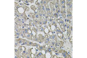 Immunohistochemistry of paraffin-embedded human liver injury using GFPT1 antibody.