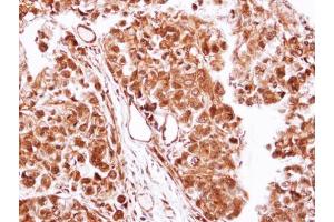 IHC-P Image Immunohistochemical analysis of paraffin-embedded CL1-0 xenograft, using Casein Kinase 2 beta, antibody at 1:100 dilution. (CSNK2B antibody)