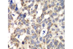 Immunohistochemistry of paraffin-embedded Human esophageal cancer using PARN Polyclonal Antibody at dilution of 1:100 (40x lens). (PARN antibody)
