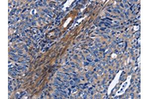 The image on the left is immunohistochemistry of paraffin-embedded Human cervical cancer tissue using ABIN7130344(NAT8 Antibody) at dilution 1/50, on the right is treated with fusion protein. (NAT8 antibody)