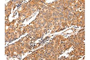 The image on the left is immunohistochemistry of paraffin-embedded Human prostate cancer tissue using ABIN7130145(MAP2 Antibody) at dilution 1/20, on the right is treated with fusion protein. (MAP2 antibody)
