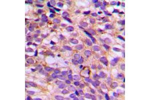 Immunohistochemical analysis of SGK223 (pY413) staining in human breast cancer formalin fixed paraffin embedded tissue section. (PRAGMIN antibody  (pTyr413))
