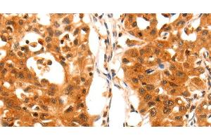Immunohistochemistry of paraffin-embedded Human lung cancer using SERPINB5 Polyclonal Antibody at dilution of 1:60 (SERPINB5 antibody)