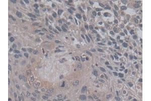 DAB staining on IHC-P; Samples: Human Lung cancer Tissue) (TGFB3 antibody  (AA 24-300))
