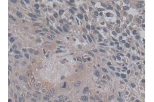 DAB staining on IHC-P; Samples: Human Lung cancer Tissue)