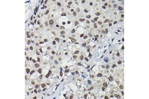 Immunohistochemistry of paraffin-embedded human breast cancer using Cyclin K Rabbit pAb (ABIN6128996, ABIN6138098, ABIN6138099 and ABIN6214445) at dilution of 1:100 (40x lens).