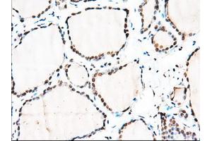 Immunohistochemical staining of paraffin-embedded Adenocarcinoma of Human colon tissue using anti-MTRF1L mouse monoclonal antibody.
