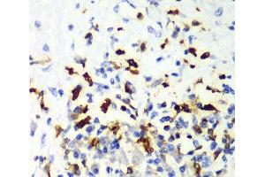 Immunohistochemistry of paraffin-embedded Human liver cancer using CAPG Polyclonal Antibody at dilution of 1:100 (40x lens).