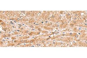 Immunohistochemistry of paraffin-embedded Human liver cancer tissue using HMGCLL1 Polyclonal Antibody at dilution of 1:70(x200) (HMGCLL1 antibody)