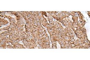 Immunohistochemistry of paraffin-embedded Human thyroid cancer tissue using AP1S1 Polyclonal Antibody at dilution of 1:65(x200)