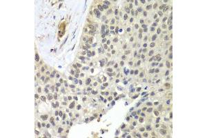 Immunohistochemistry of paraffin-embedded human lung cancer using SNRPD2 antibody. (SNRPD2 antibody  (AA 1-118))