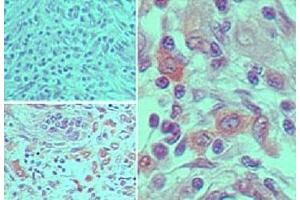 Immunohistochemical analysis of CASP7 in formalin-fixed, paraffin-embedded human cervix tumor tissue using an isotype control (top left) and CASP7 monoclonal antibody, clone 25B881.