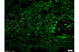 Formalin-fixed and paraffin embedded human colon carcinoma labeled Anti-IL-4R/CD124 Polyclonal Antibody, Unconjugated (ABIN740565) at 1:200 followed by conjugation to the secondary antibody Goat Anti-Rabbit IgG, AF488 conjugated used at 1:200 dilution (IL4 Receptor antibody  (AA 201-300))