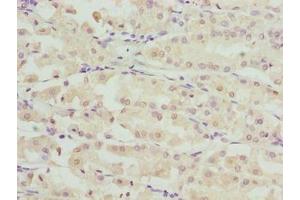Immunohistochemistry of paraffin-embedded human gastric cancer using ABIN7168087 at dilution of 1:100 (RIBC2 antibody  (AA 1-309))