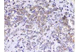IHC analysis of beta Catenin using anti-beta Catenin antibody . (CTNNB1 antibody  (AA 2-233))