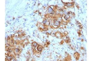 Formalin-fixed, paraffin-embedded human Gastric Carcinoma stained with CA19-9 Mouse Monoclonal Antibody (121SLE).