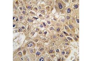 IHC analysis of FFPE human hepatocarcinoma tissue stained with AMFR antibody (AMFR antibody  (AA 571-601))