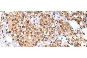 Immunohistochemistry of paraffin-embedded Human breast cancer tissue using KEAP1 Polyclonal Antibody at dilution of 1:35(x200) (KEAP1 antibody)