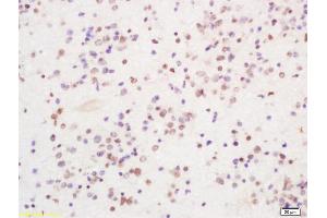 Formalin-fixed and paraffin embedded human glioma tissue labeled with Anti PIRH2 Polyclonal Antibody, Unconjugated (ABIN1386185) at 1:200 followed by conjugation to the secondary antibody and DAB staining (RCHY1 antibody  (AA 31-130))