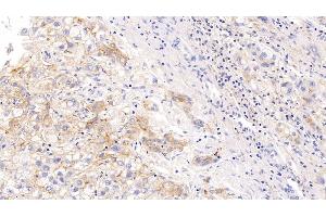Detection of ICAM1 in Human Liver cancer Tissue using Monoclonal Antibody to Intercellular Adhesion Molecule 1 (ICAM1) (ICAM1 antibody  (AA 41-464))