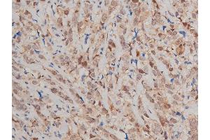 ABIN6269240 at 1/200 staining human breast cancer tissue sections by IHC-P. (STAT3 antibody  (C-Term))