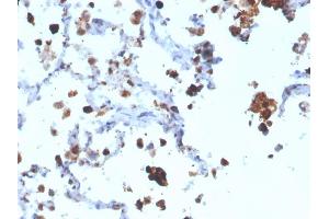 Formalin-fixed, paraffin-embedded human Lung Adenocarcinoma stained with Napsin A Mouse Monoclonal Antibody (NAPSA/3308). (NAPSA antibody  (AA 189-299))