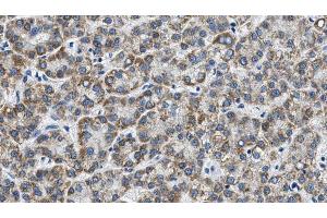 ABIN6268691 at 1/100 staining Human liver cancer tissue by IHC-P. (TJP1 antibody)