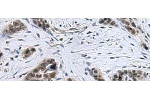 Immunohistochemistry of paraffin-embedded Human thyroid cancer tissue using CCAR2 Polyclonal Antibody at dilution of 1:40(x200) (CCAR2 antibody)