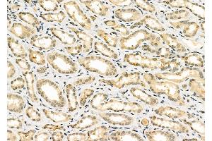 ABIN6261466 and ABIN6266885 at 1/100 staining Human kidney cancer and adjacent normal tissues by IHC-P. (EGR1 antibody  (Internal Region))