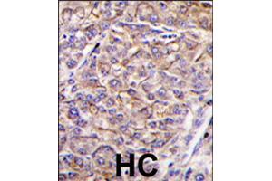 Formalin-fixed and paraffin-embedded human hepatocellular carcinoma reacted with TAOK3 polyclonal antibody  , which was peroxidase-conjugated to the secondary antibody, followed by DAB staining .