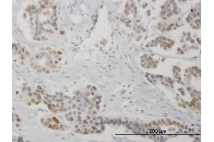Immunoperoxidase of monoclonal antibody to STK17A on formalin-fixed paraffin-embedded human colon cancer. (STK17A antibody  (AA 301-413))