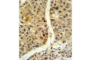 Formalin-fixed and paraffin-embedded human hepatocarcinoma reacted with NOS3 Antibody (N-term), which was peroxidase-conjugated to the secondary antibody, followed by DAB staining. (ENOS antibody  (N-Term))