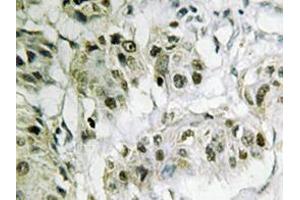 Immunohistochemistry analyzes of CtBP2 antibody in paraffin-embedded human breast carcinoma tissue. (CTBP2 antibody)