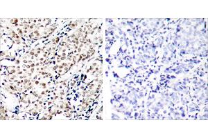 P-Peptide - +Immunohistochemical analysis of paraffin-embedded human breast carcinoma tissue using Chk1 (phospho-Ser345) antibody. (CHEK1 antibody  (pSer345))