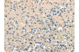 The image on the left is immunohistochemistry of paraffin-embedded Human liver cancer tissue using ABIN7131395(TMPRSS11A Antibody) at dilution 1/30, on the right is treated with fusion protein. (TMPRSS11A antibody)