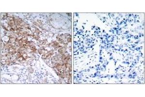 Immunohistochemistry analysis of paraffin-embedded human breast carcinoma tissue, using IGF1R (Ab-1161) Antibody. (IGF1R antibody  (AA 1126-1175))