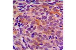 Immunohistochemical analysis of LYPLA1 staining in human breast cancer formalin fixed paraffin embedded tissue section. (LYPLA1 antibody  (Center))