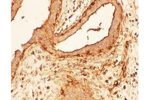 IHC-P: Cofilin antibody testing of human breast cancer tissue (Cofilin antibody  (AA 2-166))