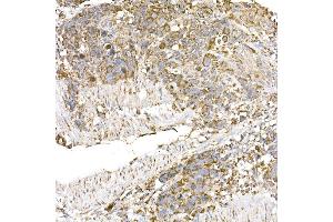 Immunohistochemistry of paraffin-embedded human esophageal cancer using GC1q R/C1QBP antibody (ABIN7266473) at dilution of 1:25 (40x lens). (C1QBP antibody)