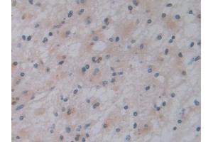 Detection of PTF1a in Human Glioma Tissue using Polyclonal Antibody to Pancreas Specific Transcription Factor 1a (PTF1a) (PTF1A antibody  (AA 177-328))